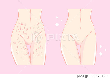 woman with stretch mark skin woman with stretch mark skin 36978459