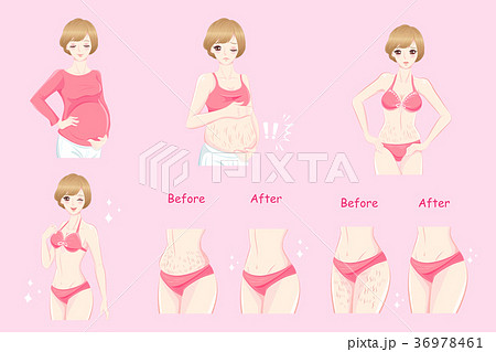 woman with stretch mark skin 36978461