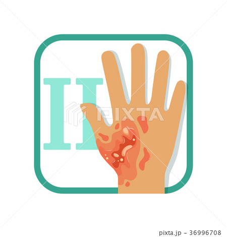 Training card showing second degree burn. Redness 36996708