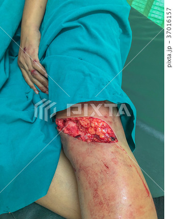left below the knee wound left below the knee wound 37016157