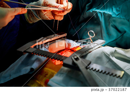 Invasive surgical approach surgery transcatheter  37022187
