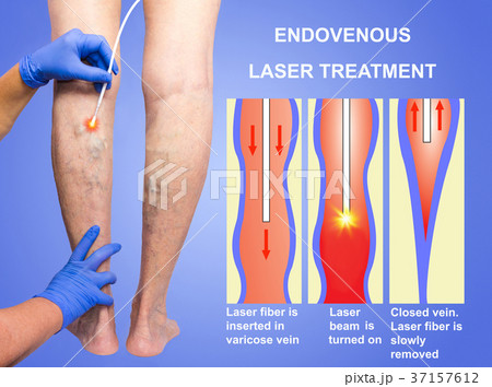 Varicose Veins and laser Varicose Veins and laser 37157612