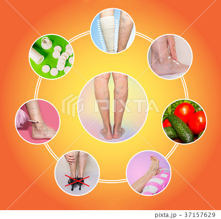 Treatment of varicose veins Treatment of varicose veins 37157629