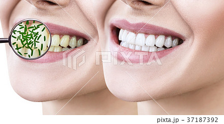 Female smile before and after teeth cleaning from Female smile before and after teeth cleaning from 37187392