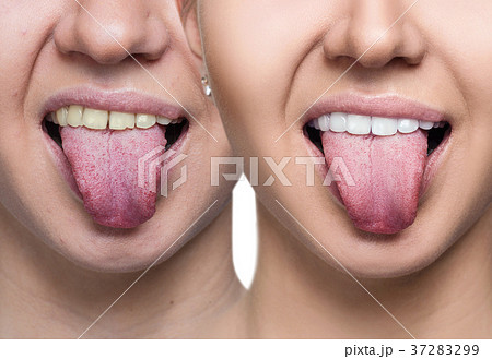 Teeth of young woman before and after whitening. 37283299