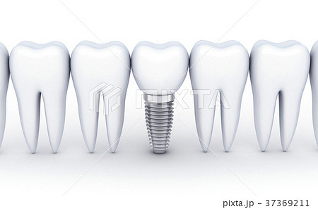 Dental Row And One Implantのイラスト素材