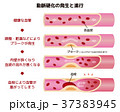 動脈硬化の発生と進行のイラスト 37383945
