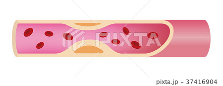 動脈硬化が進行し血流が鈍くなった動脈 血管 のイラスト素材