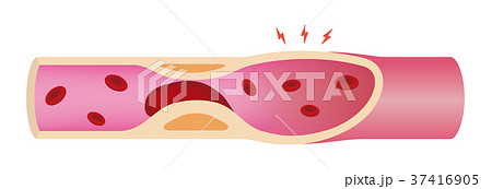 血栓により血流が塞がった動脈 血管 のイラスト素材