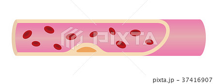 動脈硬化（初期）を引き起こした動脈（血管） 37416907