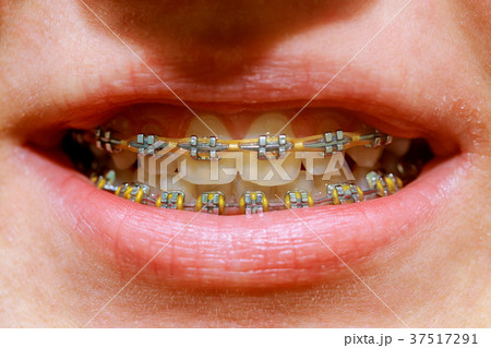 Beautiful macro shot of white teeth with braces. 37517291
