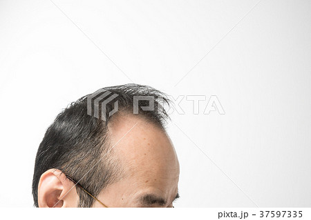 ミドル男性　薄毛 37597335