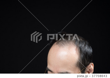 ミドル男性　薄毛 37708643