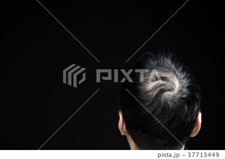 男性の後頭部　薄毛 37713449