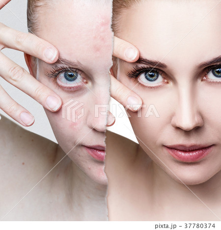 Compare of old photo with acne and new healthy Compare of old photo with acne and new healthy 37780374