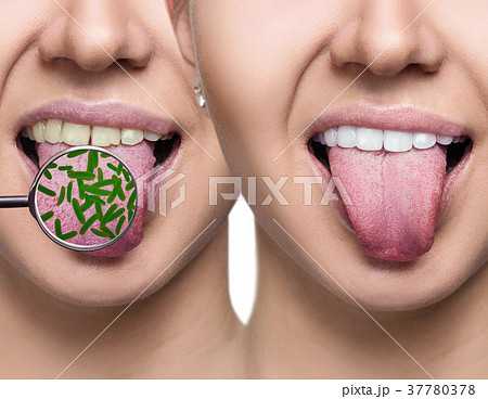 Female smile before and after teeth cleaning from 37780378