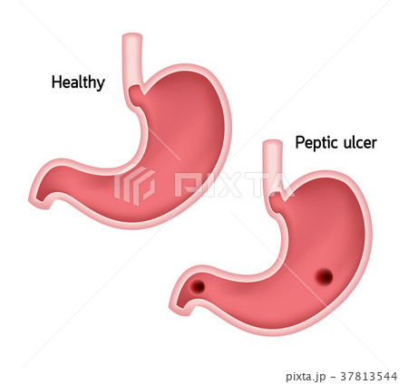 Stomach comparison, healthy and ulcer. 37813544