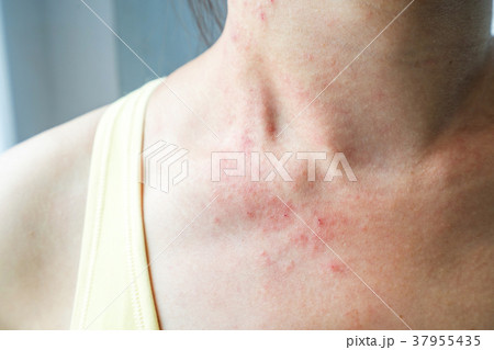 Young woman has skin rash itch on neck 37955435