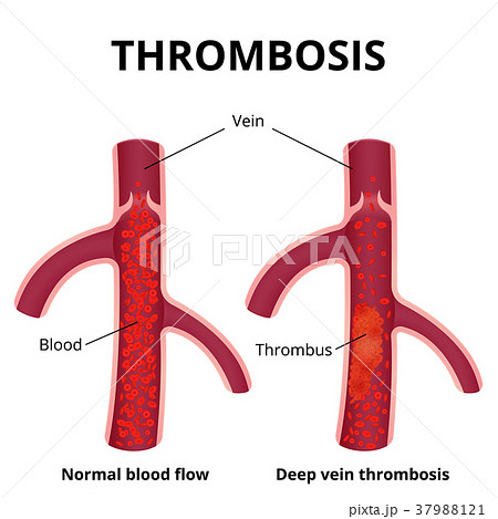 thrombus formation 37988121