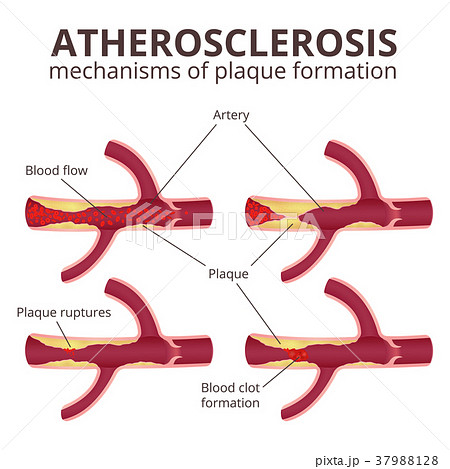 coronary artery disease coronary artery disease 37988128