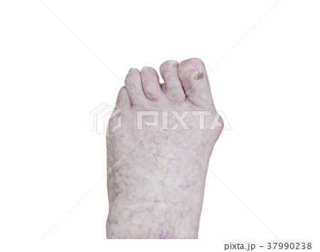 foot with arthritis, damaged nails foot with arthritis, damaged nails 37990238