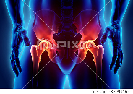 Hip painful skeleton x-ray, 3D illustration. 37999162