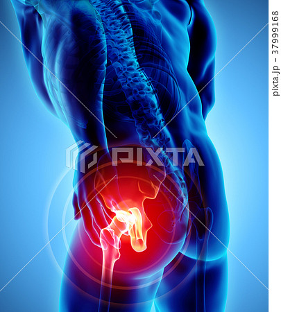 Hip painful skeleton x-ray, 3D illustration. 37999168