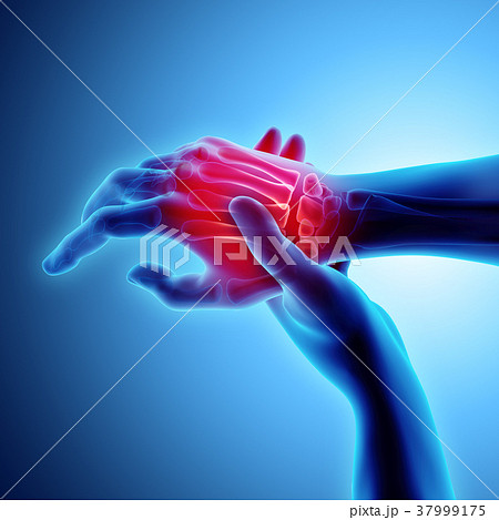 Palm painful - skeleton x-ray, Medical concept. 37999175