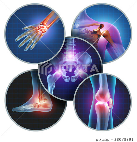 Human Painful Joints 38078391
