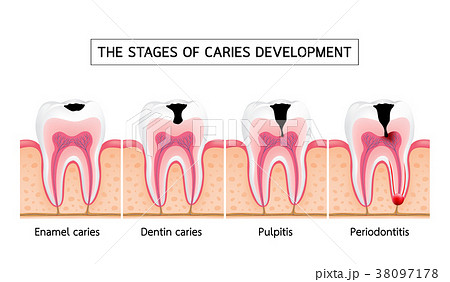 Stages of caries development. Stages of caries development. 38097178