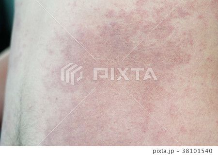 Close up Allergy rash on a man skin 38101540
