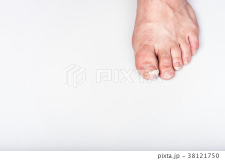 Abandoned fingers on legs, dirty, uncut nails Abandoned fingers on legs, dirty, uncut nails 38121750