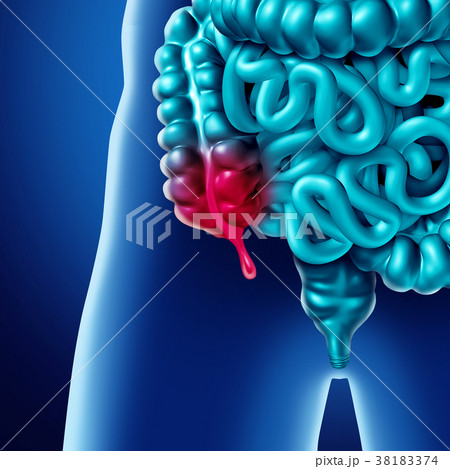 Appendix Pain 38183374
