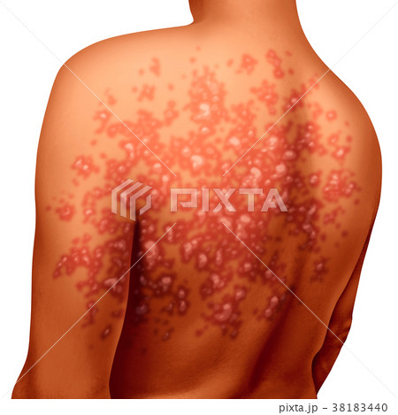 Psoriasis Illness 38183440