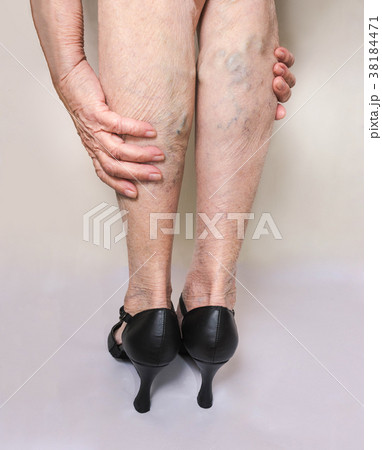 Painful varicose and spider veins on female legs Painful varicose and spider veins on female legs 38184471