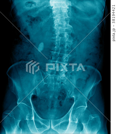 scoliosis thoracic spine  38194421