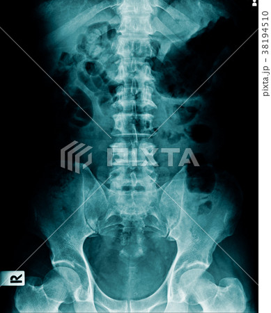 xray lumbar xray lumbar 38194510