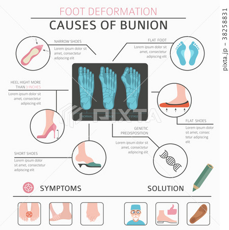 Foot deformation medical bunion infographic Foot deformation medical bunion infographic 38258831