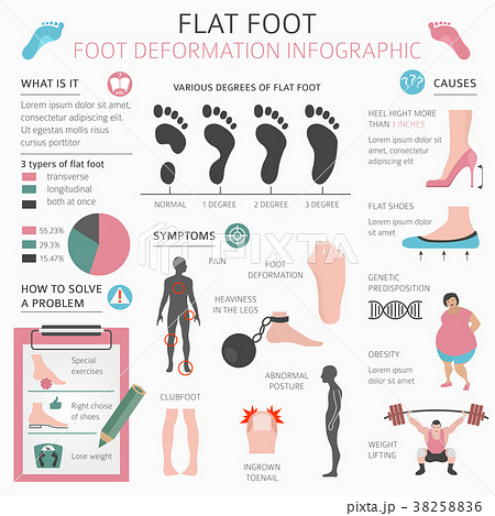 Foot deformation flat foot medical infographic Foot deformation flat foot medical infographic 38258836