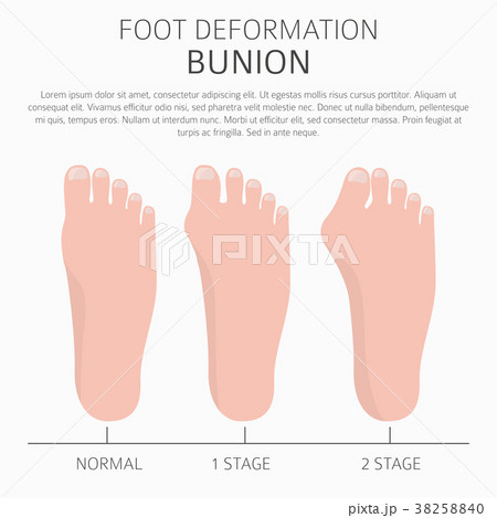 Foot deformation medical bunion infographic Foot deformation medical bunion infographic 38258840
