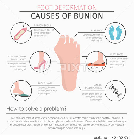Foot deformation. Bunion infographic 38258859