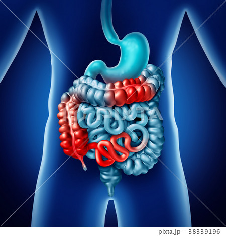 Crohn illness 38339196