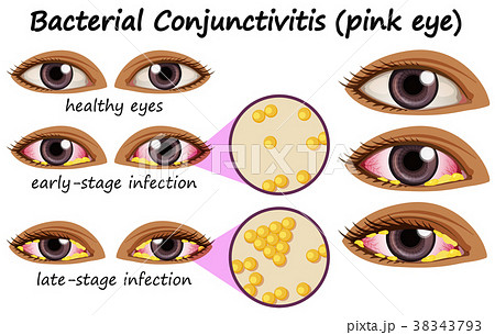 Diagram showing bacterial conjunctivitis 38343793