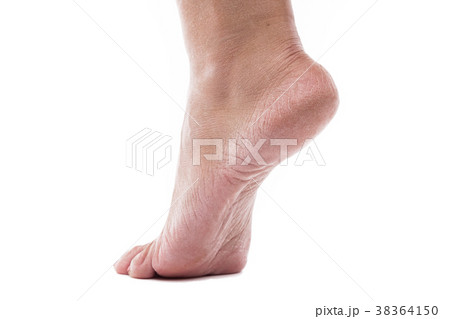 dehydrated skin on the heels of female feet 38364150