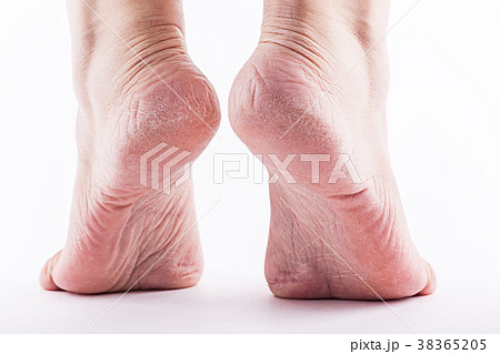 Dry heels woman on a white background closeup Dry heels woman on a white background closeup 38365205