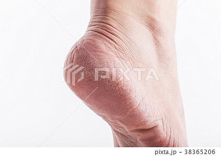 Dry heels woman on a white background closeup 38365206