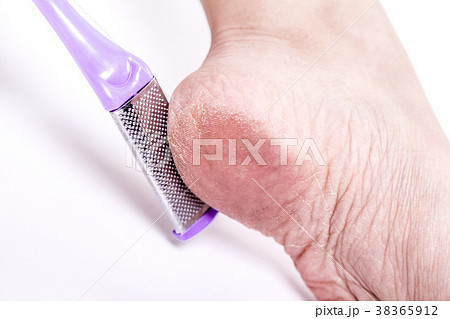 female legs with overdried dehydrated dry skin on 38365912