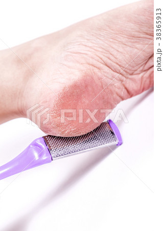 female legs with overdried dehydrated dry skin on female legs with overdried dehydrated dry skin on 38365913