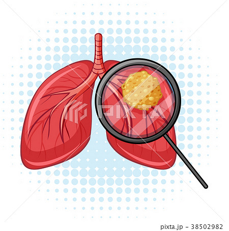 Cancer in human lungs 38502982