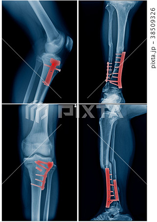 collection leg with internal fixation collection leg with internal fixation 38509326